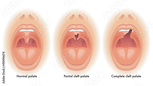 Medical illustration shows the difference between a normal palate, a partial cleft palate, and a complete cleft palate, with annotations.
