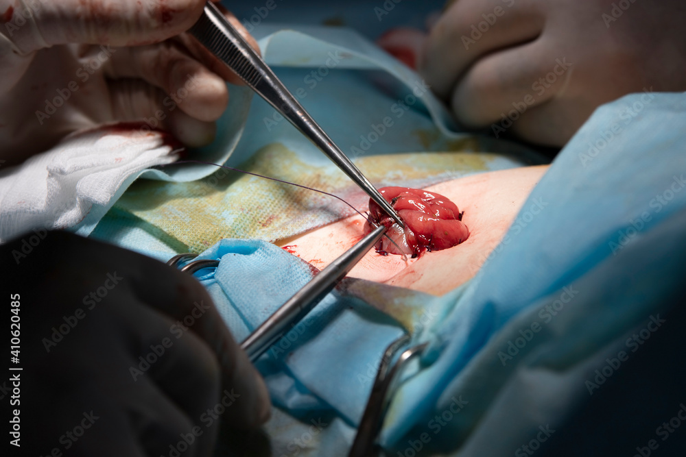 Surgeon finishes the colostomy operation sewing the gut close-up