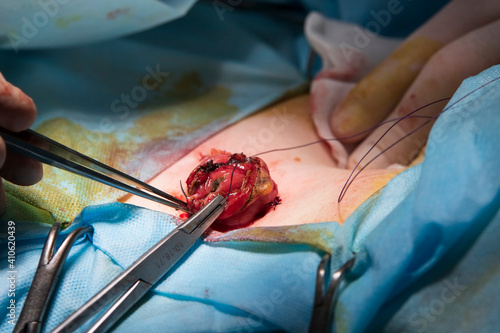 Sewing the stoma at the finish of surgery close-up