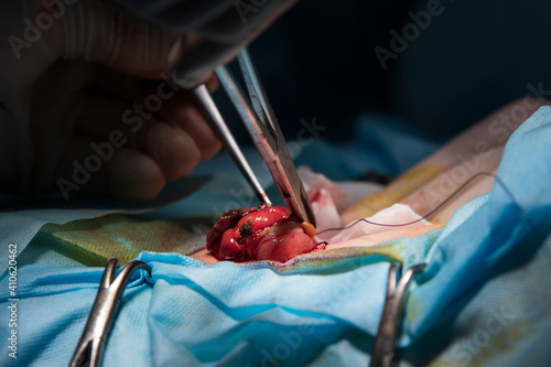 Surgeon sews the stoma close-up at the end of surgery