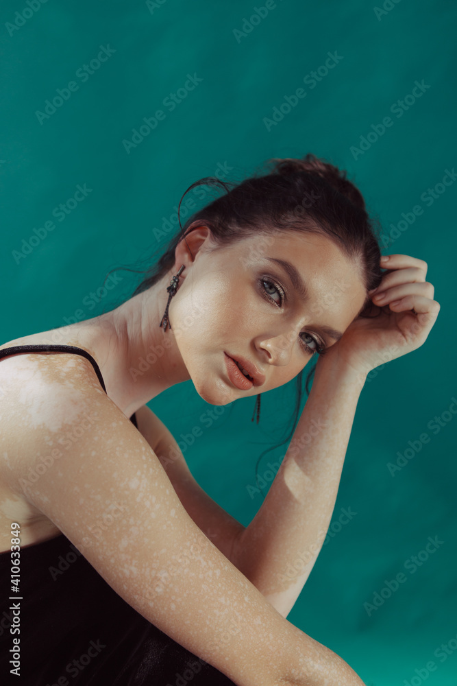 Fashion beauty portraits of a girl in a black dress and with vitiligo