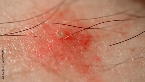 rash on skin Insect bites close up