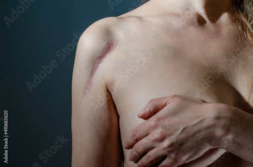 Colloidal scar on woman shoulder after surgery, installation of metal plate on bone. High contrast, dramatic photo. Medical illustration, concept
