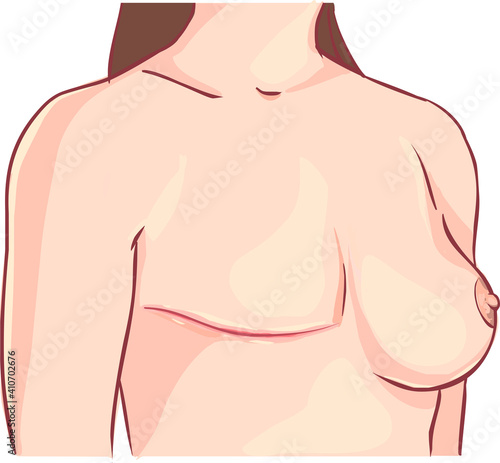 Mastectomy breast cancer illustration. Woman with one breast. Vector illustration