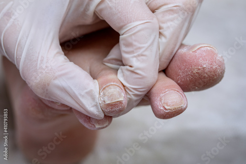 Broken toenail. Problematic diabetic foot in a woman. Dry skin on the sole and chapped toes. Medical hardware pedicure in a beauty salon.