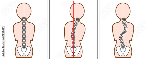 側弯症　Scoliosis