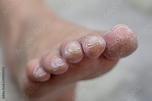 Problematic diabetic foot in a woman. Dry skin on the sole and chapped toes. Medical hardware pedicure in a beauty salon.