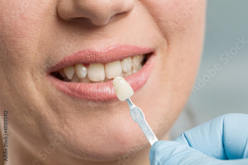 close up of using a shade guide to check veneer of teeth for bleaching