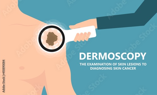 Melanocytes stages exam skin cancer cell screening diagnosis dermis dermoscopic basal surface mole keratosis test Mohs keratoses solar sun UV expose detect treat sunburn