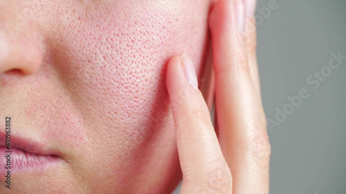 Skin texture with enlarged pores. Part of a woman's face photo