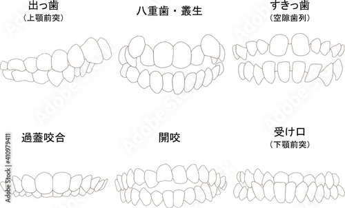 歯列矯正治療の対象になる代表的な症例セット（歯のみ）　ベタ塗り線あり