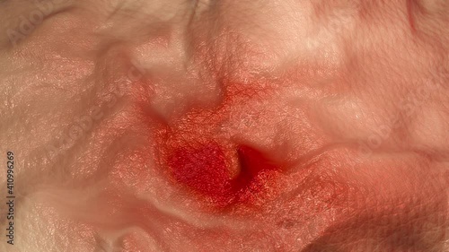 Medical 3D Animation of a close-up of skin inflammation causing red and irritated tissue.