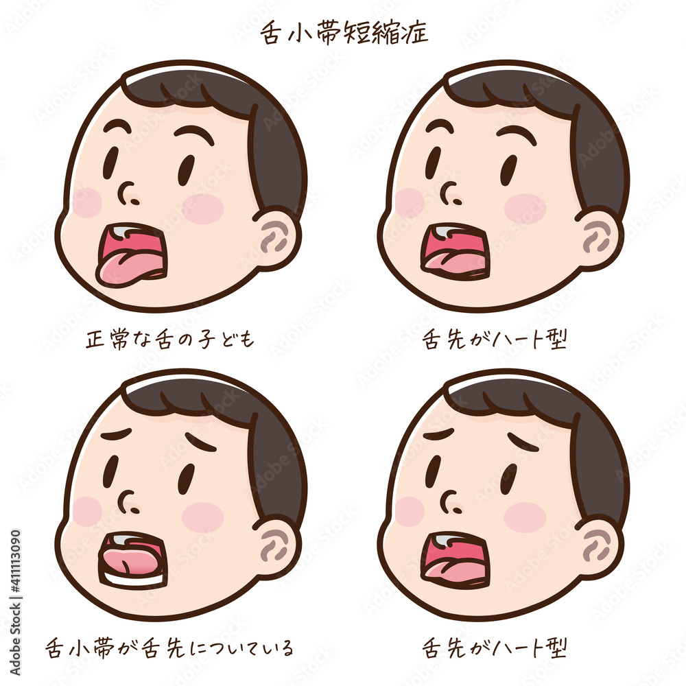 舌小帯短縮症の子どものイラスト 舌小帯短縮症の子どものイラスト