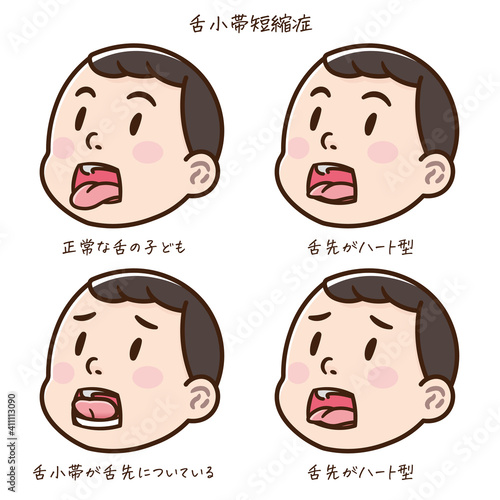 舌小帯短縮症の子どものイラスト