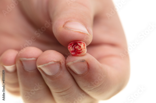 Close up of a tooth in blood in a hand on a white background.