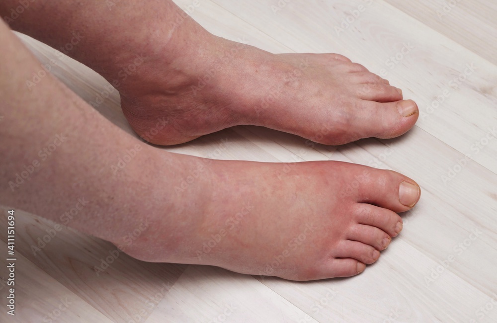 Painful allergic reaction caused by an insect bite Painful allergic reaction caused by an insect bite