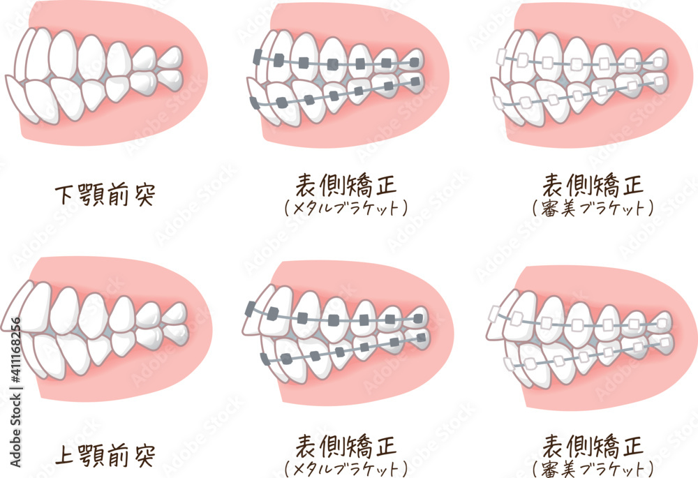 歯列矯正のイラスト Stock Vector Adobe Stock