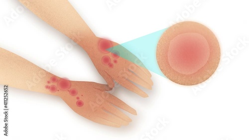 From healthy skin to grow rashes, becoming red and sensitive skin on both hands. 