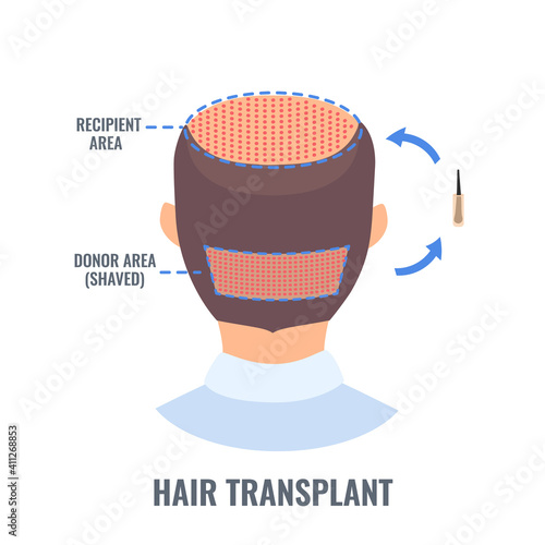 Male alopecia treatment with FUE hair transplantation method. Follicular unit extraction diagram of donor site and recipient area. Medical infographics. Vector illustration.