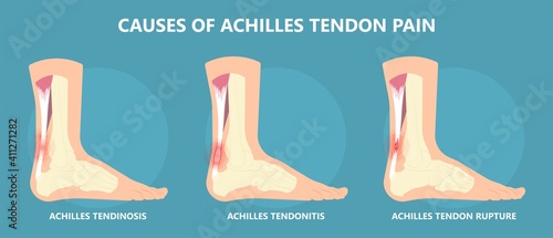 Achilles tendon rupture injury Feet calf test range of motion slight ache problem limb Thompson Simmonds