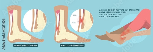 Achilles tendon rupture injury Feet calf test range of motion slight ache problem limb Thompson Simmonds