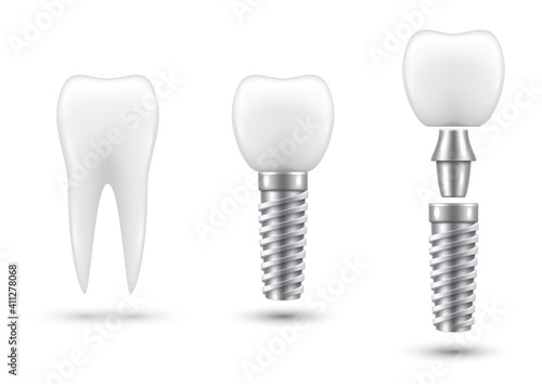 Dental implant, healing abutment or cap, crown. Artificial tooth, stages of implantation.
