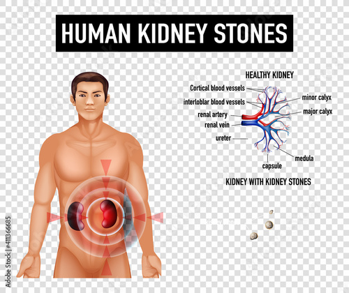 Diagram showing human kidney stones on transparent background