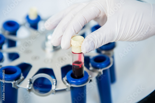Platelet-Rich plasma preparation. Tube with blood in hands