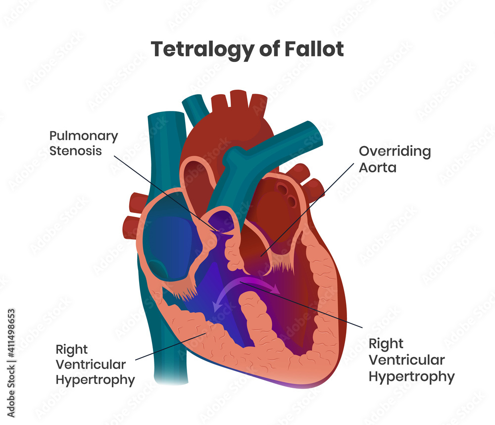 Tetralogie van Fallot samenstelling van de hartafwijkingen.  Vectorillustratie van de aangeboren hartafwijking #411498653 - Textielposter