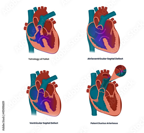 Vector illustration of the heart defects linked to the Down syndrome: septal defects, tetralogy of Fallot and patent ductur arteriosus