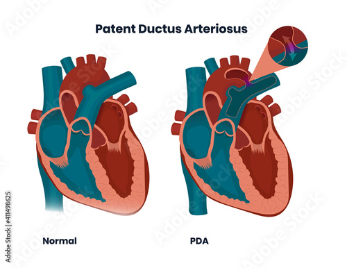 Patent ductus arteriosus with normal heart anatomy. Illustration of the congenital heart anomaly photo