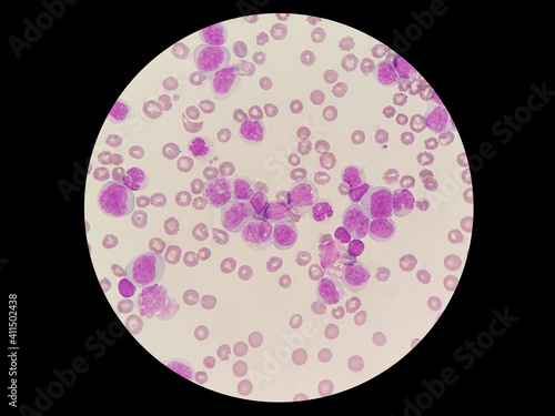 Canvas Print Acute myeloid leukemia (AML) is a type of blood cancer