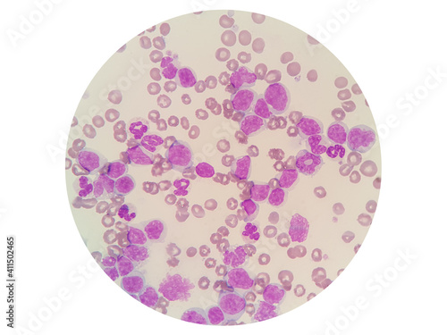 Acute myeloid leukemia (AML) is a type of blood cancer. Microscopic examination of blasts or leukemia cells  in blood smear of dog. photo