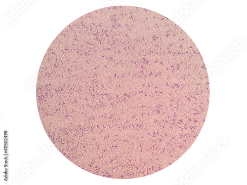 Leukemoid reaction describes an increased white blood cell count, or leukocytosis, which is a physiological response to stress or infection. Canine peripheral blood smear under light microscope.