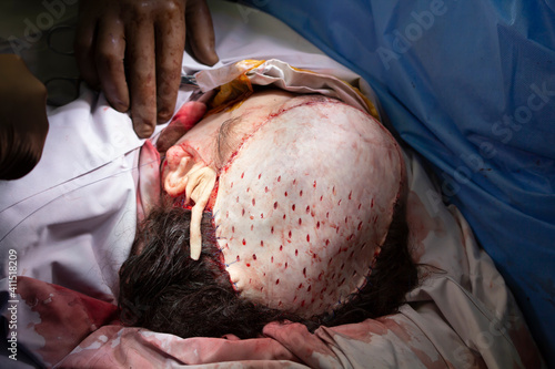 Head skin grafting surgery close-up with sewed down skin flap and drainage openings made © vzmaze