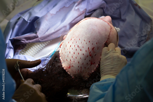 Head skin grafting surgery close-up with surgeons finishing the sewing of the skin flap with drainage openings photo