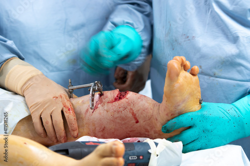Leg surgery with Ilizarov apparatus installation close-up
