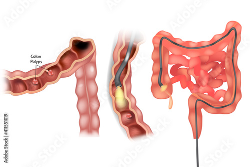Removal polyps of the Colon. Colonoscopy medical illustration