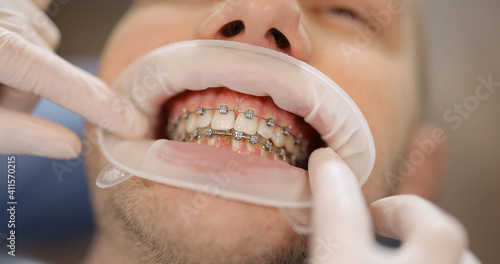 Patient with dental braces during an orthodontic treatment. Close-up on a patient s mouth opened with dental optragate. 4k video screenshot  please use in small size