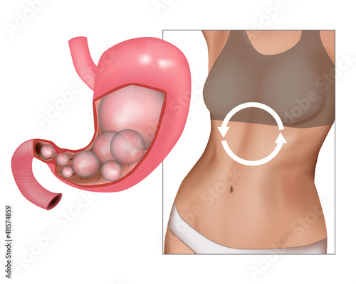 Realistic medical illustration abdominal bloated. Feeling bloated concept, woman having abdominal pain.