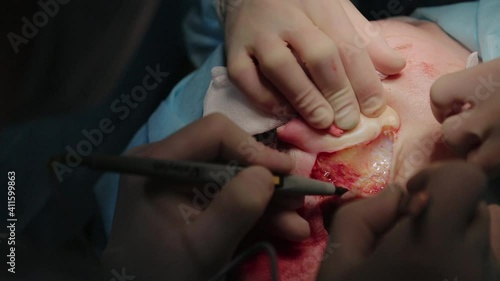 Plastic surgeon performs facelift surgery with a scalpel, tweezers and clamps, close up. High quality FullHD footage