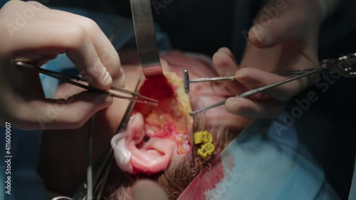 Plastic surgeon performs facelift surgery with a scalpel, tweezers and clamps, close up. High quality FullHD footage