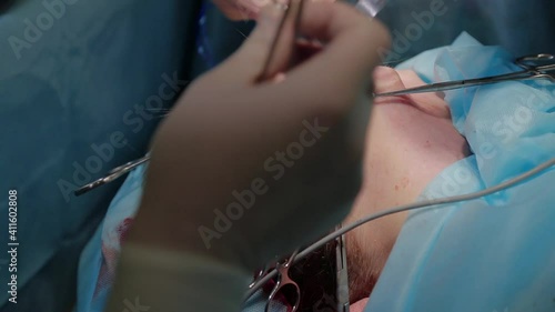 Plastic surgeon performs facelift surgery with a scalpel, tweezers and clamps, close up. High quality FullHD footage