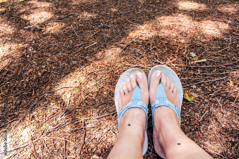 Legs with many red spot and scar from insect bites. Mosquitos allergy