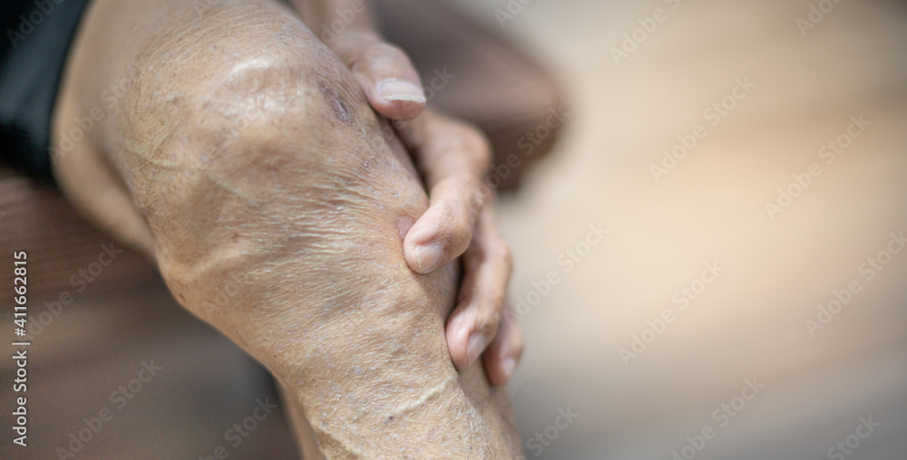 Naklejka premium Close up of old man hand holding on the knee with suffering from knee pain. The sick legs of an old man with severely deformed knees affected by arthritis.