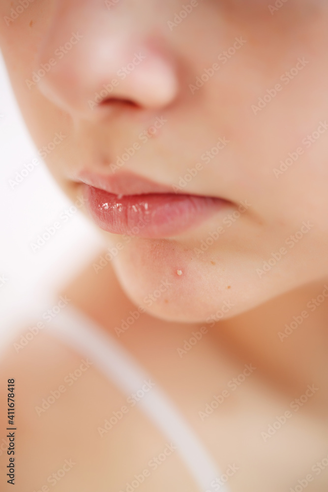 Fototapeta premium Teenage acne on the chin. Close up face with pimple. Teen problem. High quality photo.