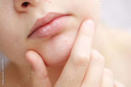 Teenage acne on the chin. Close up face with pimple. Teen problem. High quality photo.