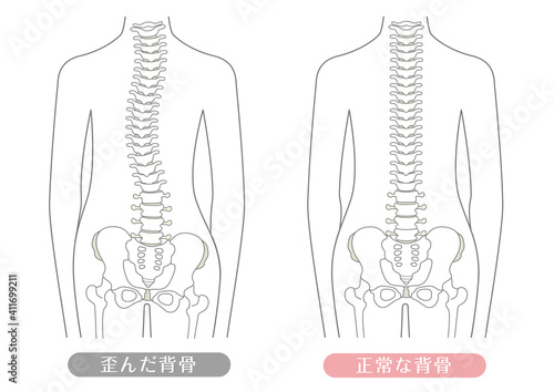 人間の体 正常な背骨と歪んだ背骨