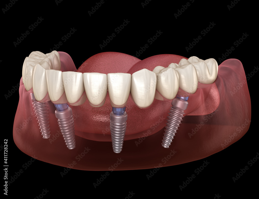 Mandibular prosthesis All on 4 system supported by implants. Medically accurate 3D illustration of human teeth and dentures concept Mandibular prosthesis All on 4 system supported by implants. Medically accurate 3D illustration of human teeth and dentures concept