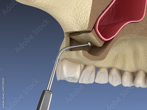 Sinus Lift Surgery - Moving sinus membrane. 3D illustration photo